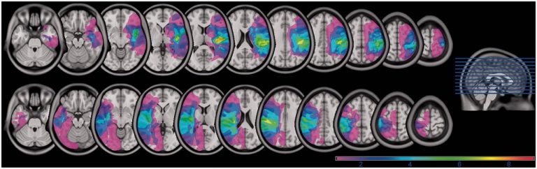 Az indonéz egészségügyi miniszter saját fejlesztésű terápiát vezet be a stroke kezelésében