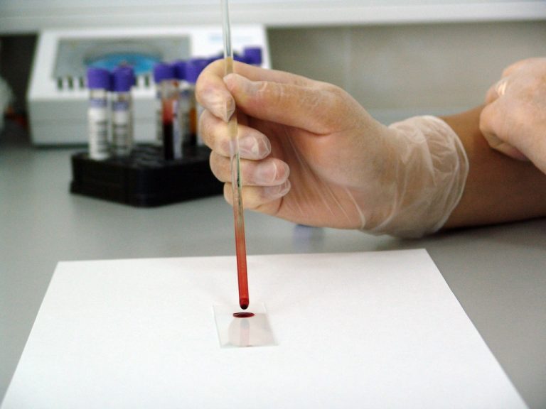 A jövőben vérvizsgálat mutathatja ki korai stádiumban az Alzheimer-kórt