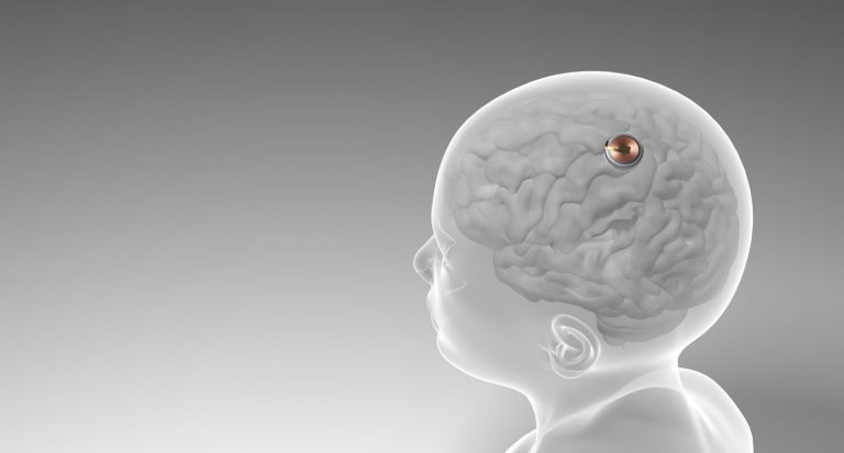 Kihívta egy Pong meccsre a Neuralink implantátumával ellátott majmot egy mozgássérült férfi